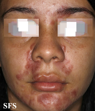 File:Sarcoidosis (Dermatology Atlas 22).jpg
