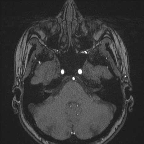 A1 segment hypoplasia (Radiopaedia 83365-97781 Axial TOF MRA 36).jpg