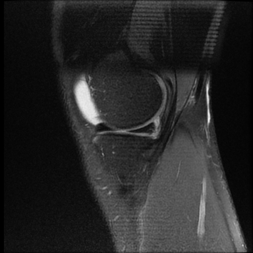 File:ACL acute full thickness tear - deep lateral femoral sulcus sign (Radiopaedia 38594-40740 Sagittal PD fat sat 4).jpg