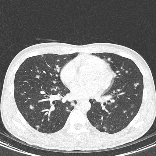 File:AIDS-related Kaposi sarcoma (Radiopaedia 85247-100811 Axial lung window 102).jpg