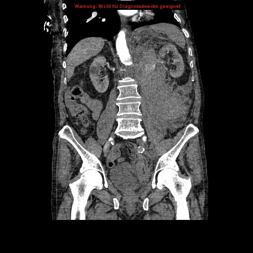 Abdominal aortic aneurysm- extremely large, ruptured (Radiopaedia 19882-19921 Coronal C+ arterial phase 62).jpg