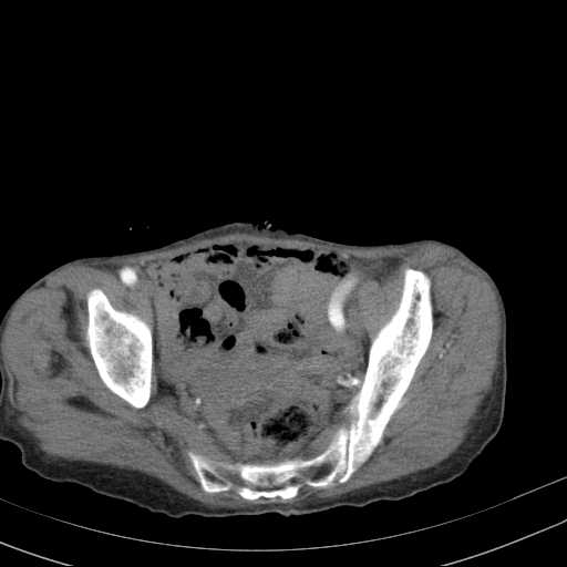 File:Abdominal aortic aneurysm (Radiopaedia 20827-20742 Axial C+ arterial phase 33).jpg