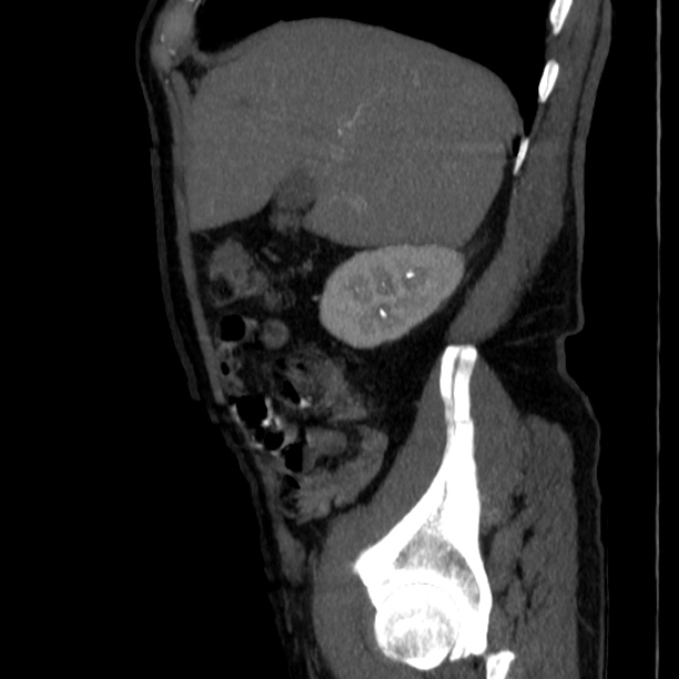 Abdominal aortic aneurysm (Radiopaedia 29248-29660 Sagittal C+ arterial phase 12).jpg