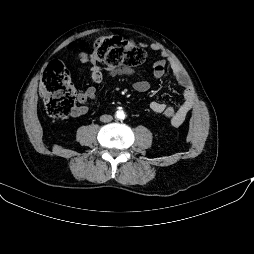 Abdominal aortic aneurysm (Radiopaedia 67117-76452 Axial C+ arterial phase 80).jpg
