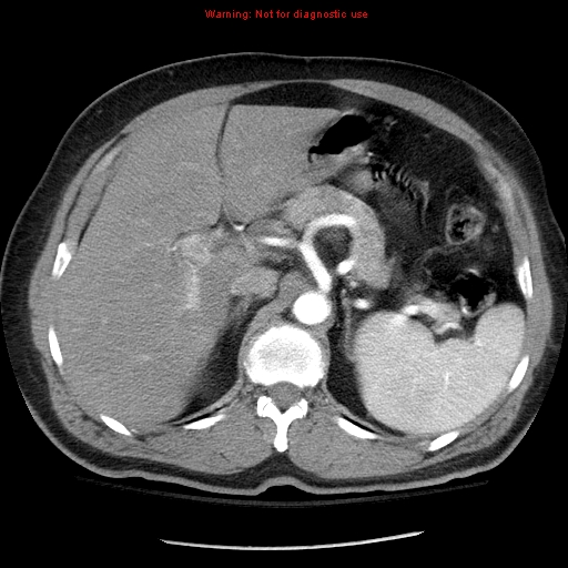 Abdominal aortic aneurysm (Radiopaedia 8190-9038 Axial C+ arterial phase 24).jpg