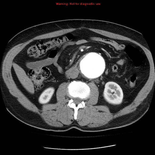 Abdominal aortic aneurysm (Radiopaedia 8190-9038 Axial C+ arterial phase 39).jpg