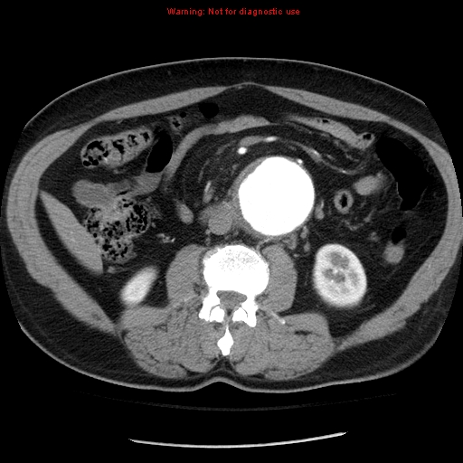 Abdominal aortic aneurysm (Radiopaedia 8190-9038 Axial C+ arterial phase 40).jpg