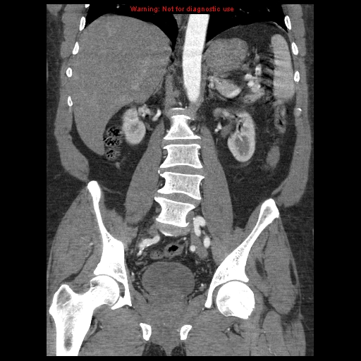Abdominal aortic aneurysm (Radiopaedia 8190-9038 Coronal C+ arterial phase 77).jpg