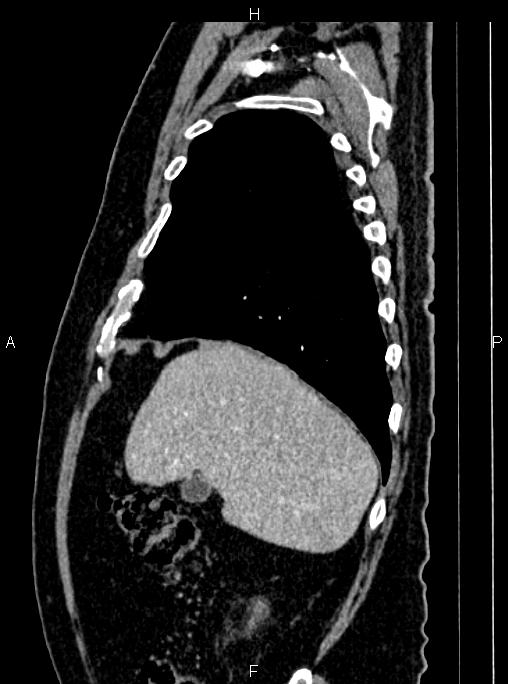 Abdominal aortic aneurysm (Radiopaedia 83094-97462 Sagittal renal cortical phase 29).jpg
