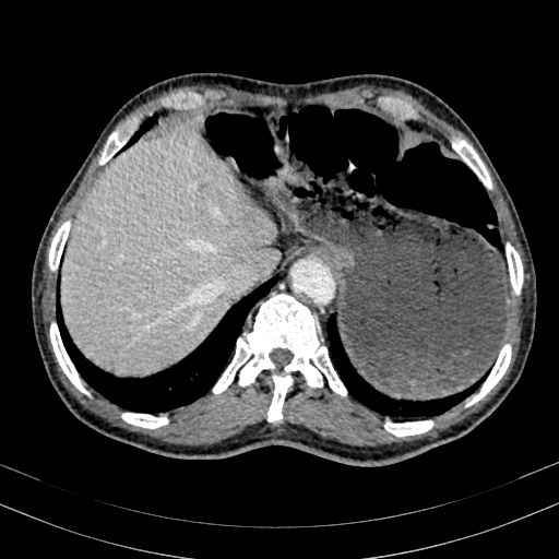 File:Abdominal aortic aneurysm (Radiopaedia 83581-98689 Axial C+ portal venous phase 18).jpg