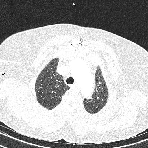 File:Abdominal aortic aneurysm (Radiopaedia 85063-100606 Axial lung window 19).jpg