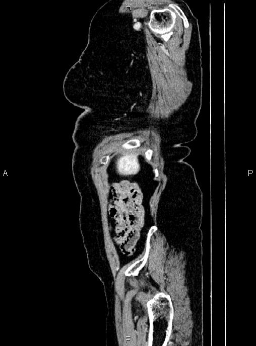 Abdominal aortic aneurysm (Radiopaedia 85063-100606 Sagittal C+ arterial phase 77).jpg