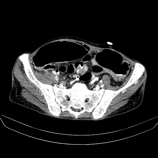 File:Abdominal collection due to previous cecal perforation (Radiopaedia 80831-94320 Axial C+ portal venous phase 158).jpg