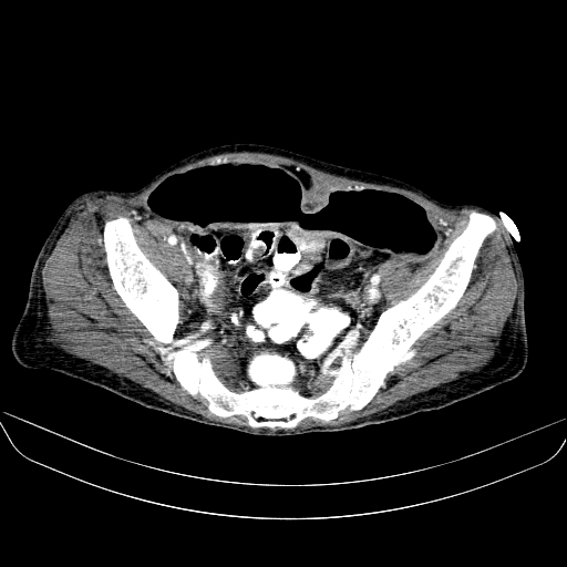 File:Abdominal collection due to previous cecal perforation (Radiopaedia 80831-94320 Axial C+ portal venous phase 170).jpg