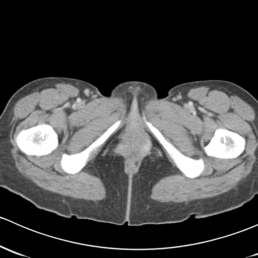 File:Abdominal desmoid tumor (Radiopaedia 41007-43740 Axial C+ portal venous phase 79).png