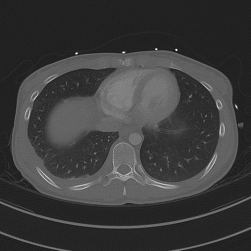 File:Abdominal multi-trauma - devascularised kidney and liver, spleen and pancreatic lacerations (Radiopaedia 34984-36486 I 64).png