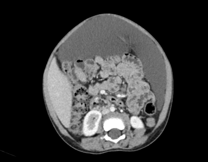 Abdominal premesenteric cystic lymphangioma (Radiopaedia 82995-97350 Axial C+ portal venous phase 31).jpg
