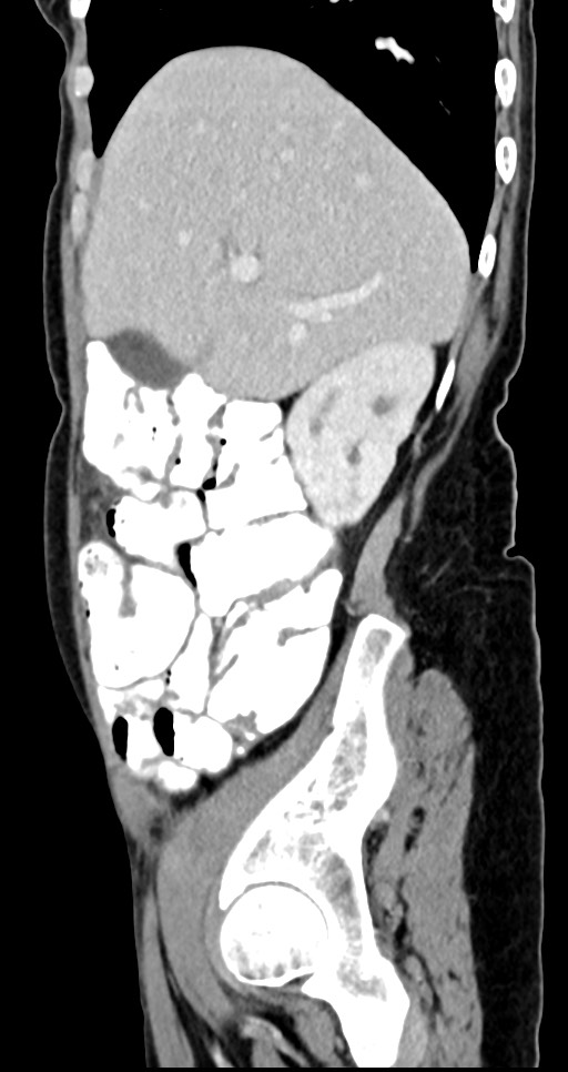 Abdominal wall and retroperitoneal tuberculosis (Radiopaedia 88137-104729 Sagittal C+ portal venous phase 112).jpg