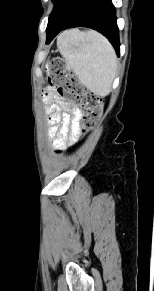 Abdominal wall and retroperitoneal tuberculosis (Radiopaedia 88137-104729 Sagittal C+ portal venous phase 24).jpg
