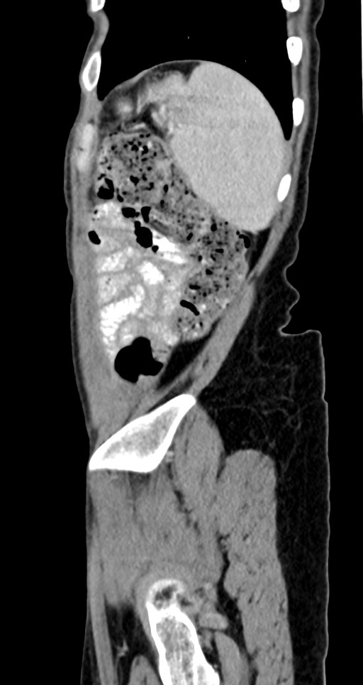 Abdominal wall and retroperitoneal tuberculosis (Radiopaedia 88137-104729 Sagittal C+ portal venous phase 27).jpg