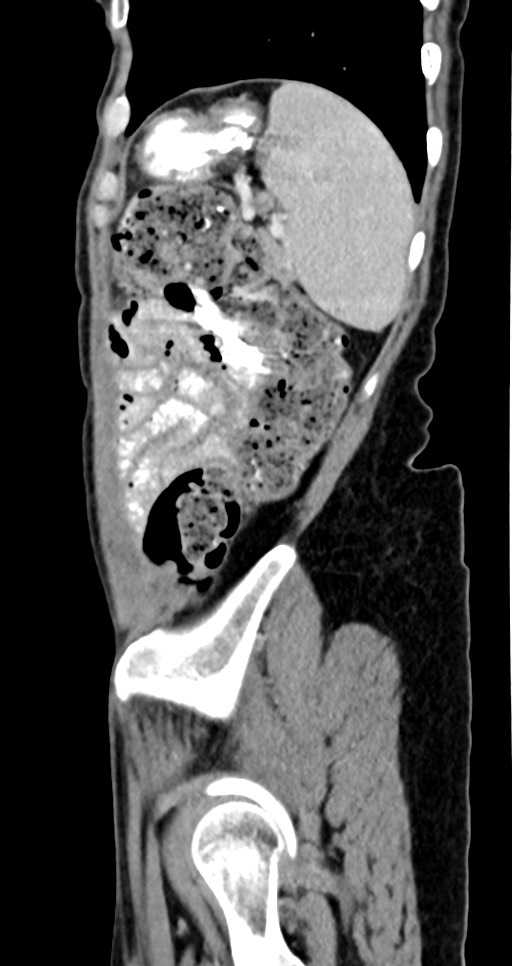 Abdominal wall and retroperitoneal tuberculosis (Radiopaedia 88137-104729 Sagittal C+ portal venous phase 31).jpg