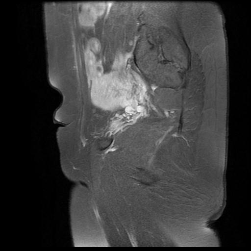 File:Abdominal wall endometriosis (Radiopaedia 83702-98847 Sagittal T1 C+ fat sat 14).jpg