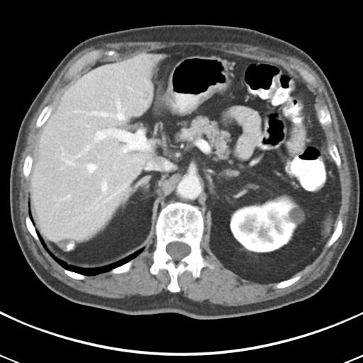 Abdominal wall metastasis from colorectal carcinoma (Radiopaedia 31016-31717 Axial C+ portal venous phase 22).jpg