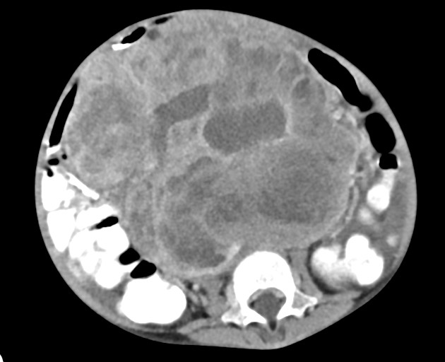 Abdominopelvic rhabdomyosarcoma (Radiopaedia 78356-90984 Axial C+ portal venous phase 101).jpg