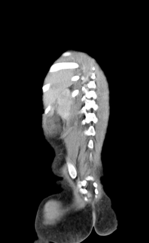 Abdominopelvic rhabdomyosarcoma (Radiopaedia 78356-90984 Coronal C+ portal venous phase 82).jpg