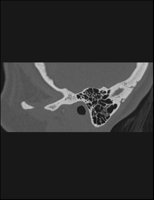 Aberrant right internal carotid artery (Radiopaedia 65191-74198 Sagittal non-contrast 20).jpg