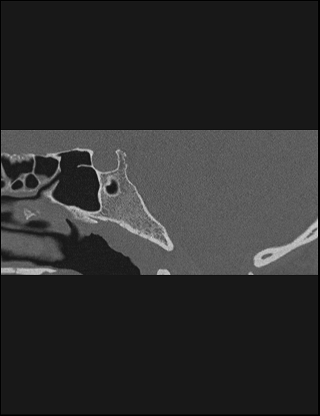 Aberrant right internal carotid artery (Radiopaedia 65191-74198 Sagittal non-contrast 99).jpg