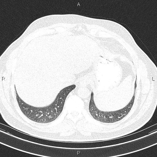 Aberrant right subclavian artery (Radiopaedia 87093-103354 Axial lung window 93).jpg