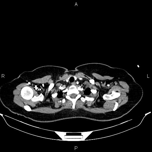 Aberrant right subclavian artery (Radiopaedia 87334-103629 Axial C+ arterial phase 8).jpg
