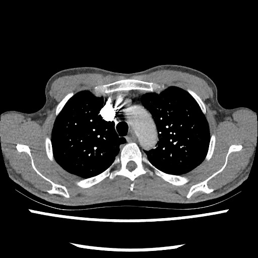 Accessory left horizontal fissure with lingular pneumonia (Radiopaedia 53763-59843 Axial C+ CTPA 26).jpg