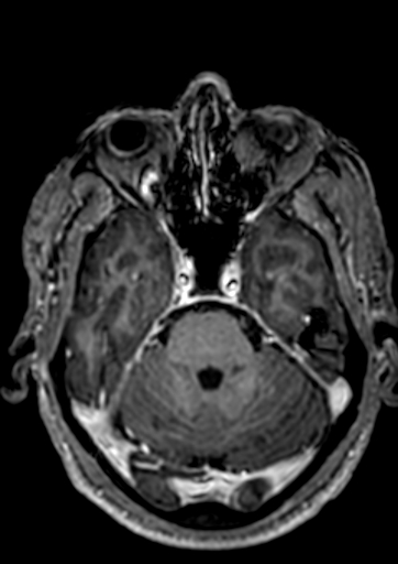 Accessory middle cerebral artery (Radiopaedia 73114-83828 Axial T1 C+ 108).jpg