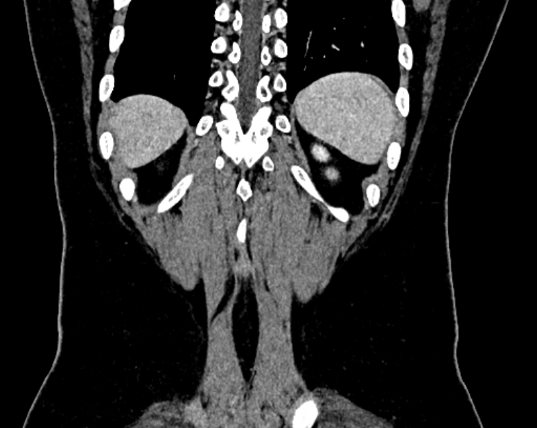 Accessory right inferior hepatic vein (Radiopaedia 75207-86305 Coronal C+ portal venous phase 74).jpg