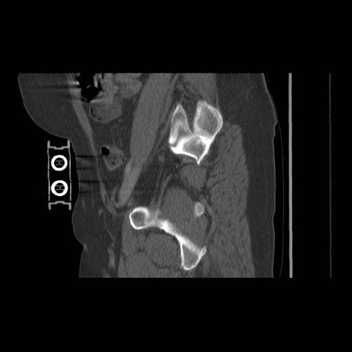 File:Acetabular fracture (Radiopaedia 13193-13212 Sagittal bone window 30).jpg