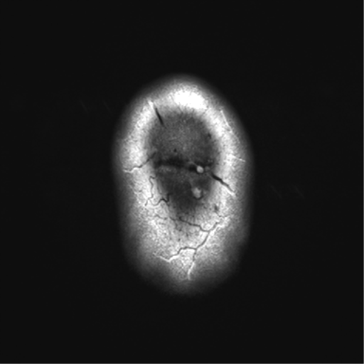File:Achondroplasia (Radiopaedia 65109-74105 Axial T2 39).png