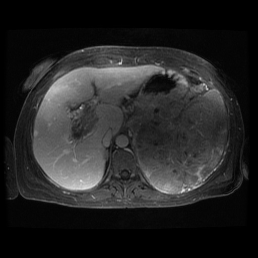 Acinar cell carcinoma of the pancreas (Radiopaedia 75442-86668 D 97).jpg