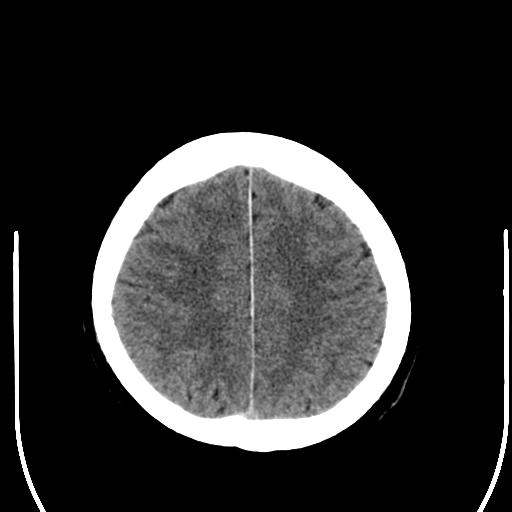 File:Acoustic schwannoma (Radiopaedia 39170-41389 Axial non-contrast 23).png