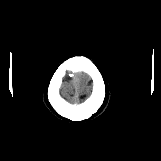 File:Acoustic schwannoma (Radiopaedia 55729-62280 Axial non-contrast 32).png