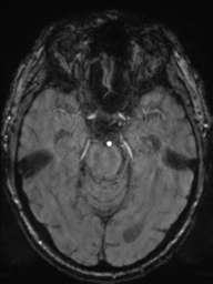 Acoustic schwannoma (Radiopaedia 55729-62281 Axial SWI 19).png