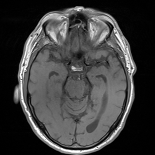 File:Acoustic schwannoma (Radiopaedia 55729-62281 T1 13).png