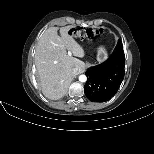 File:Acquired adrenal hyperplasia - due to thymic carcinoid tumor (Radiopaedia 21269-21184 C+ arterial phase 6).jpg