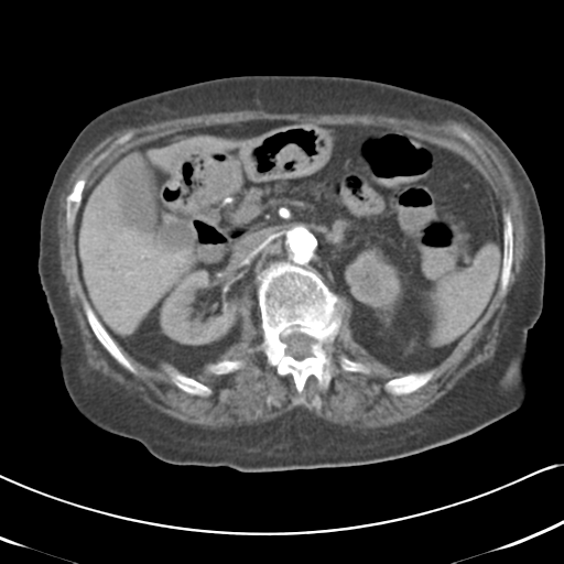 Active bleeding from duodenal ulcer with embolization (Radiopaedia 34216-35481 Axial C+ arterial phase 22).png