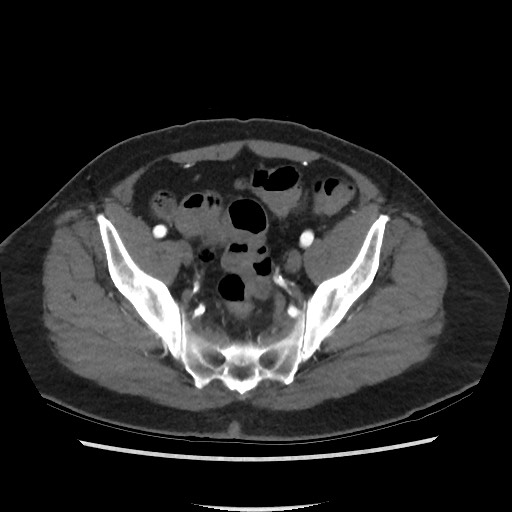 Active colonic bleed on CT (Radiopaedia 49765-55025 Axial C+ arterial phase 68).jpg
