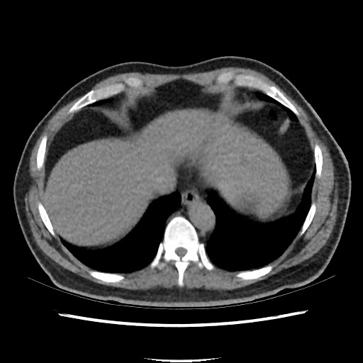 File:Active colonic bleed on CT (Radiopaedia 49765-55025 Axial non-contrast 6).jpg