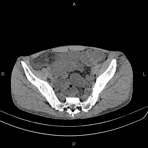 Active crohn disease (Radiopaedia 87133-103397 Axial non-contrast 84).jpg