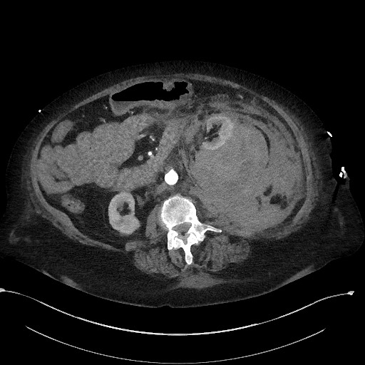 Active renal extravasation with large subcapsular and retroperitoneal hemorrhage (Radiopaedia 60975-68796 Axial C+ arterial phase 93).jpg