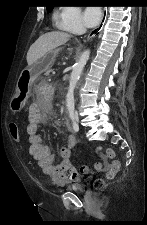 Active renal extravasation with large subcapsular and retroperitoneal hemorrhage (Radiopaedia 60975-68796 Sagittal C+ portal venous phase 122).jpg